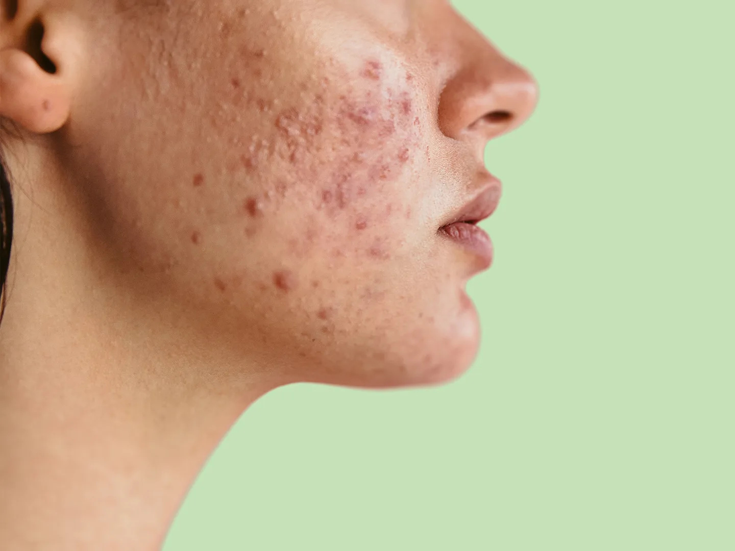 Facing Acne One Step at a Time